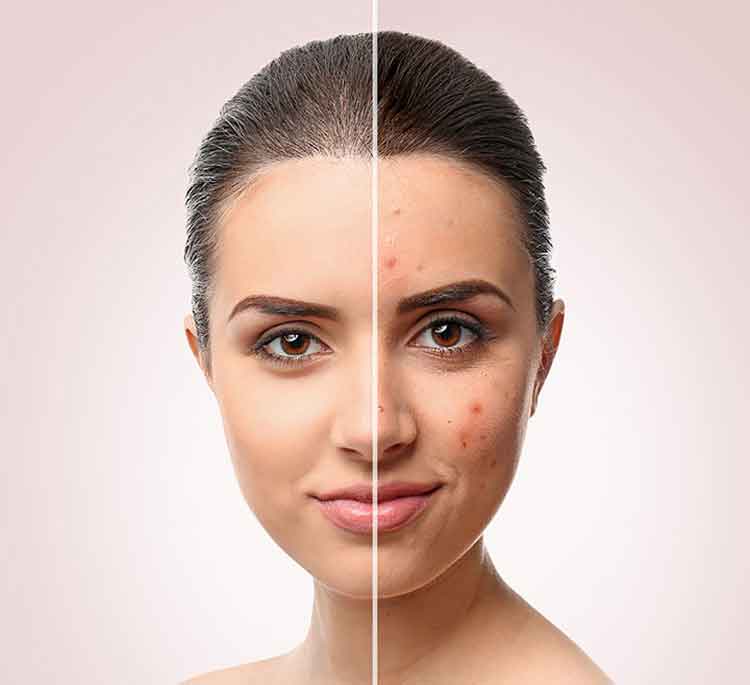 10-Simple-And-Effective-Ayurvedic-Treatments-For-Pimples