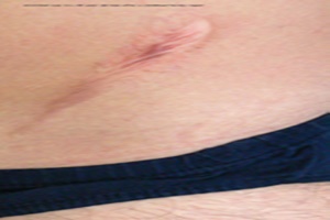 stretched scar_thumb